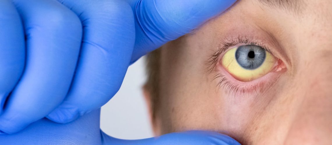 Yeux jaunes : quelles causes ? Quand consulter ?