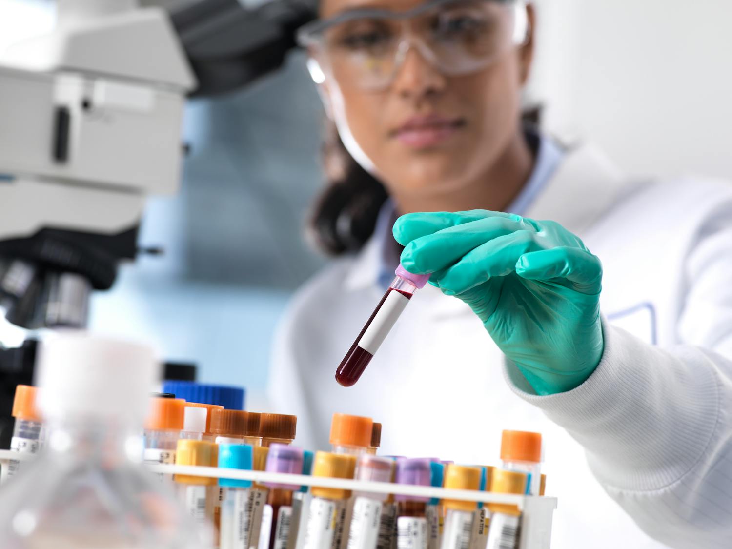 Lymphopénie : comprendre la baisse des lymphocytes et ses causes